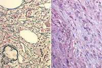 Bone marrow biopsy - marrow fibrosis