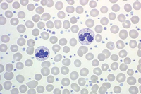 increased platelet count in essential thrombocythemia