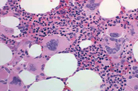 Bone marrow biopsy - megakaryocytes in essential thrombocythemia