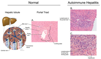 diagnostic algorithm for autoimmune hepatitis