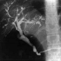 Cholangiogram of primary sclerosing cholangitis (PSC). The areas of stricturing and dilation are typical of PSC.