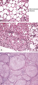 Spectrum of disease in NAFLD