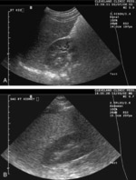 Sonographic features in fatty liver