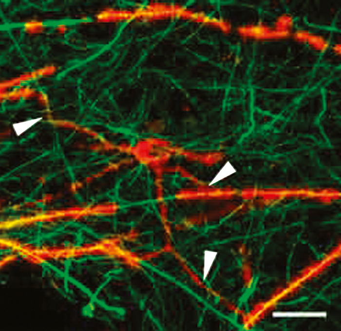 Multiple Sclerosis