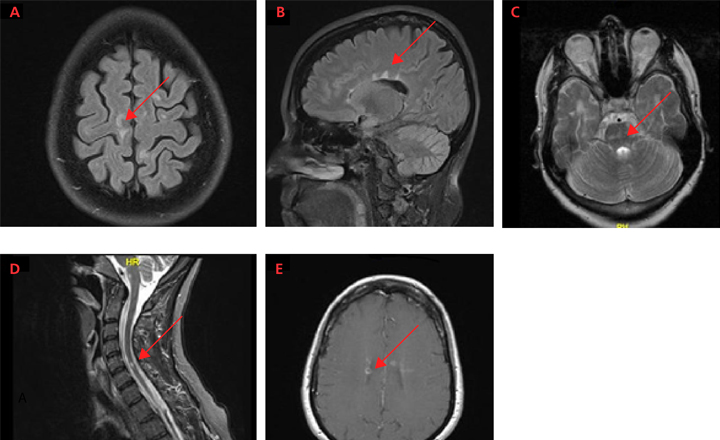 ms mri brain scan results