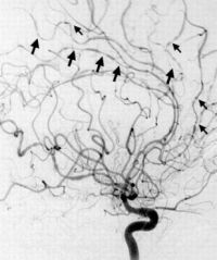Typical angiographic findings