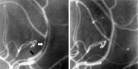 Cerebral angiography