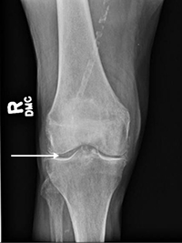 Chondrocalcinosis