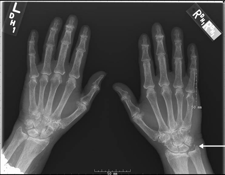 gout vs pseudogout crystals