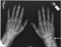 Chondrocalcinosis fibrocartilage