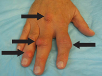 Tophi along the second proximal interphalangeal