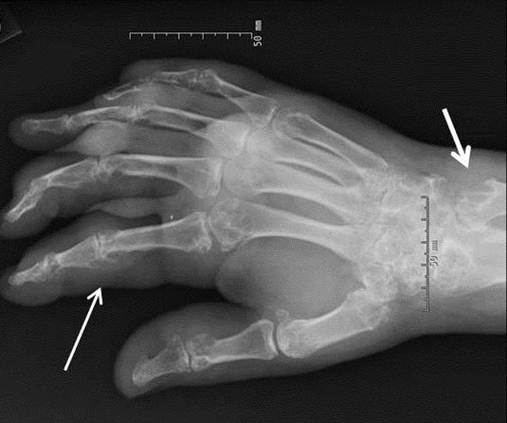 gout vs pseudogout crystals