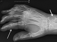 arthropathy with erosions of multiple joints
