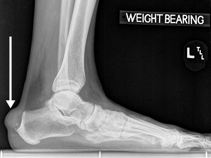 gout vs pseudogout crystals