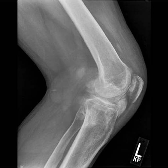 Gout and Calcium Pyrophosphate Deposition Disease