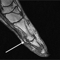 first metatarsophalangeal joint