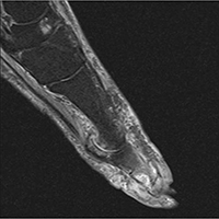 first metatarsophalangeal joint