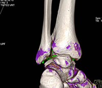 Tophi along the second proximal interphalangeal