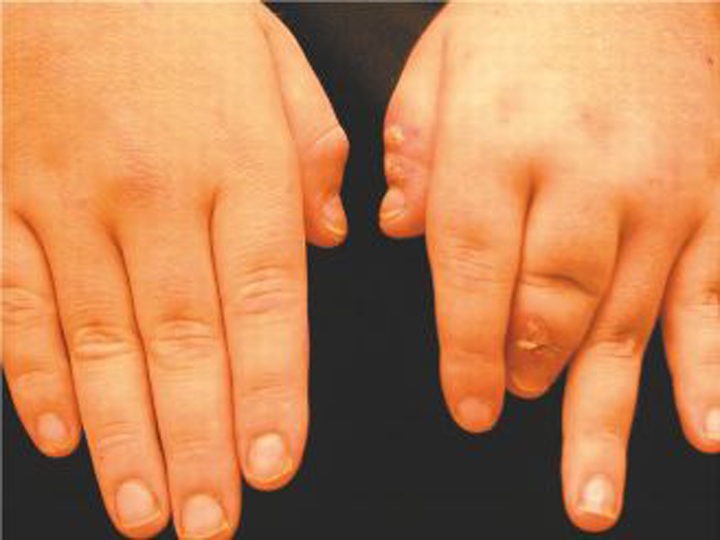 Delayed Nail Findings in Hand-Foot-and-Mouth Disease | Consultant360