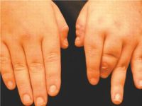 destructive arthritis of the third digit