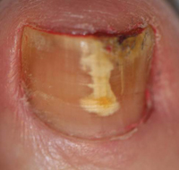 onychomycosis of the toenail