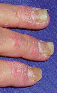 nail pitting and onycholysis