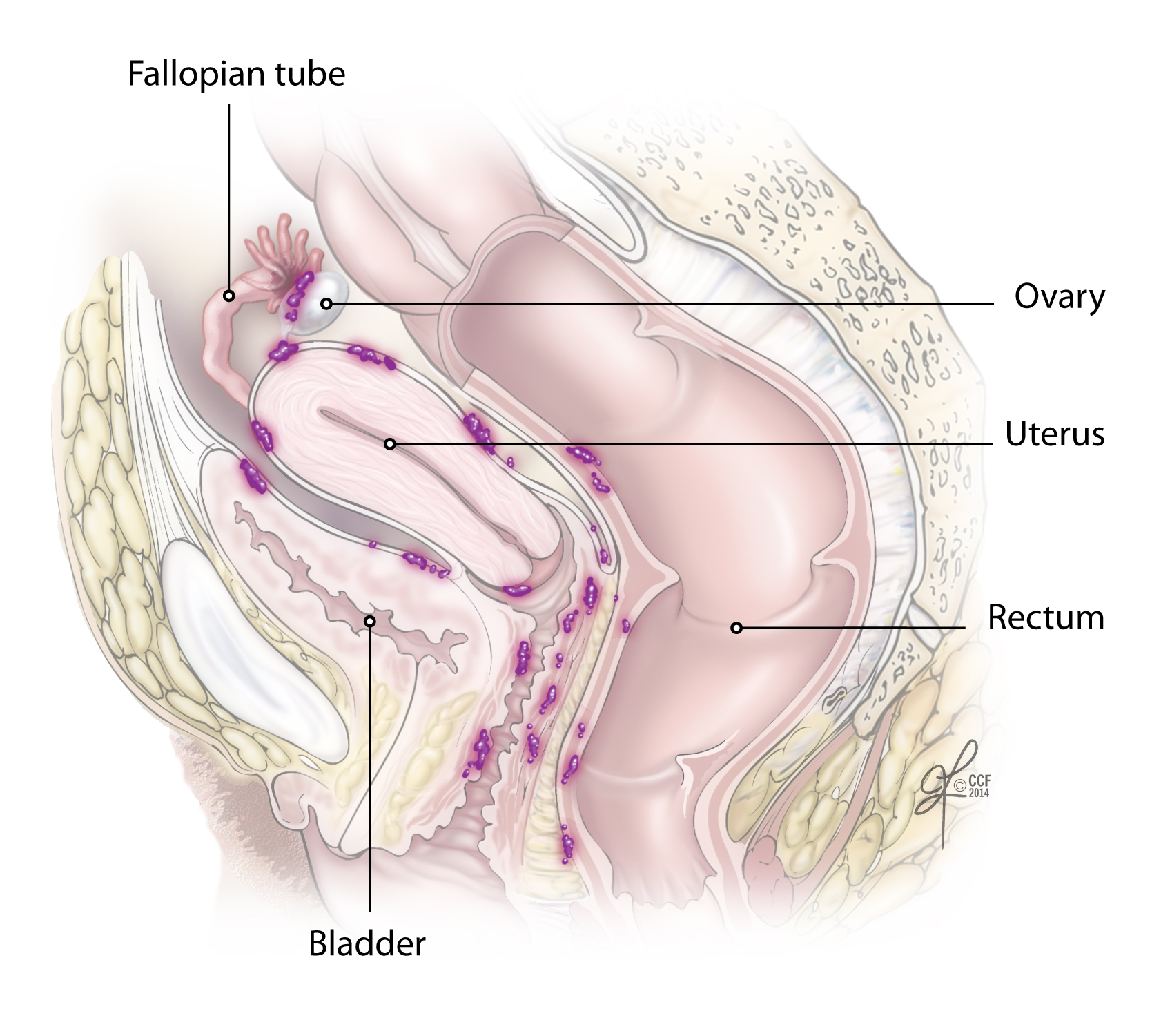 Figure 2. Ovarian cancer spreads along the peritoneal surfaces of the abdomen and pelvis, thus cytoreductive surgery often involves organs beyond the reproductive system. 