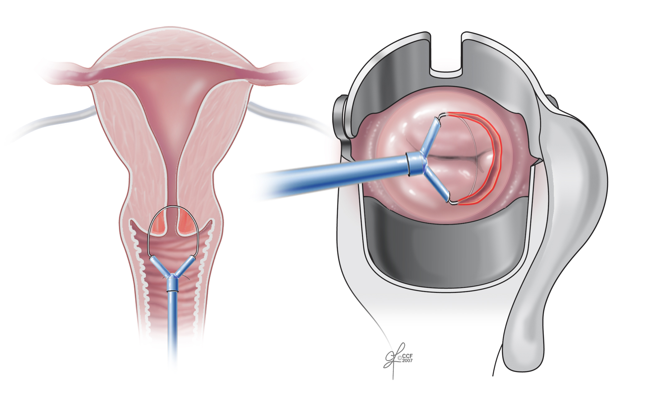 Endometrial, Ovarian, and Cervical Cancer