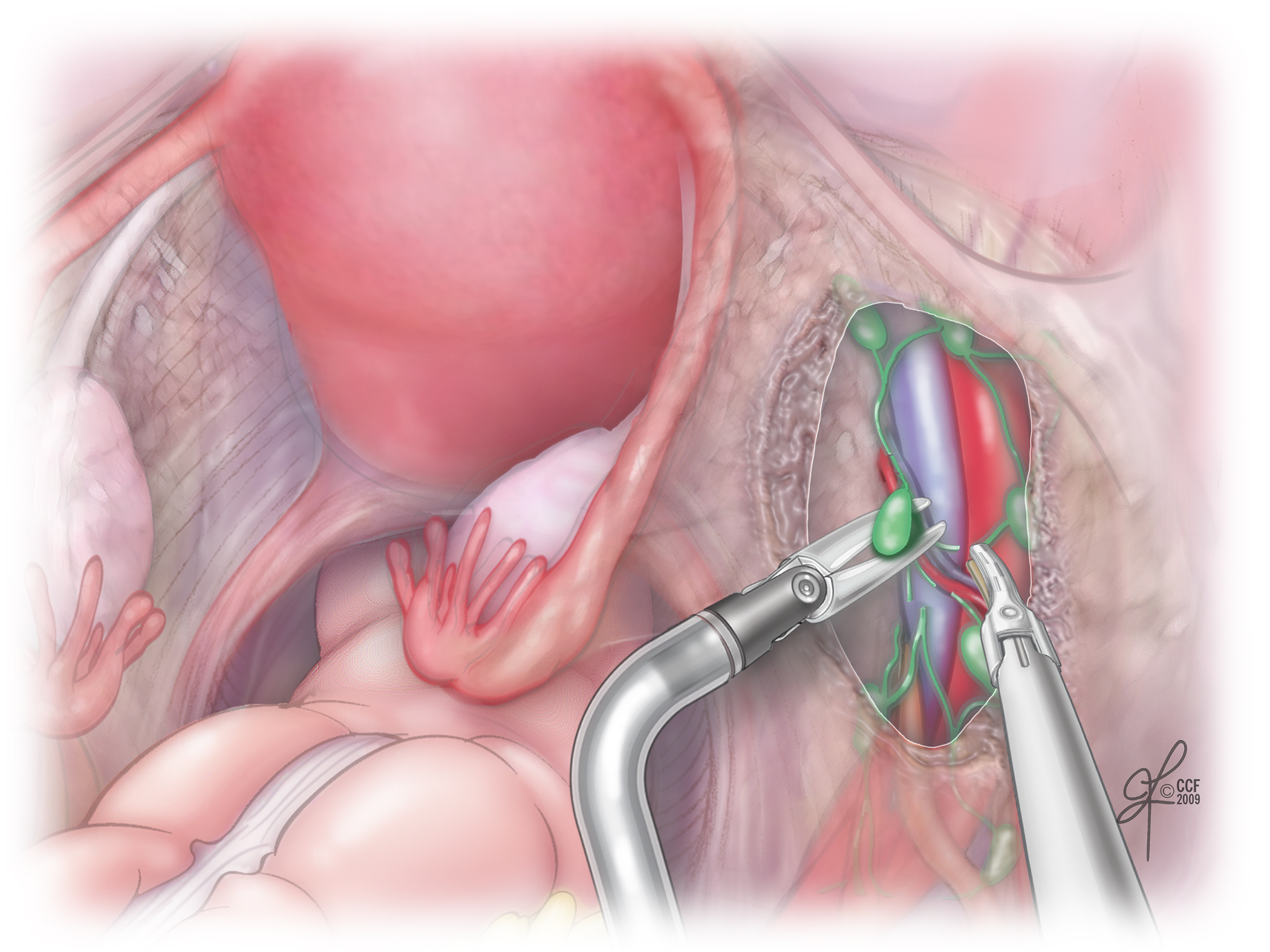 Figure 1: Pelvic lymph nodes are isolated and removed for endometrial cancer staging.