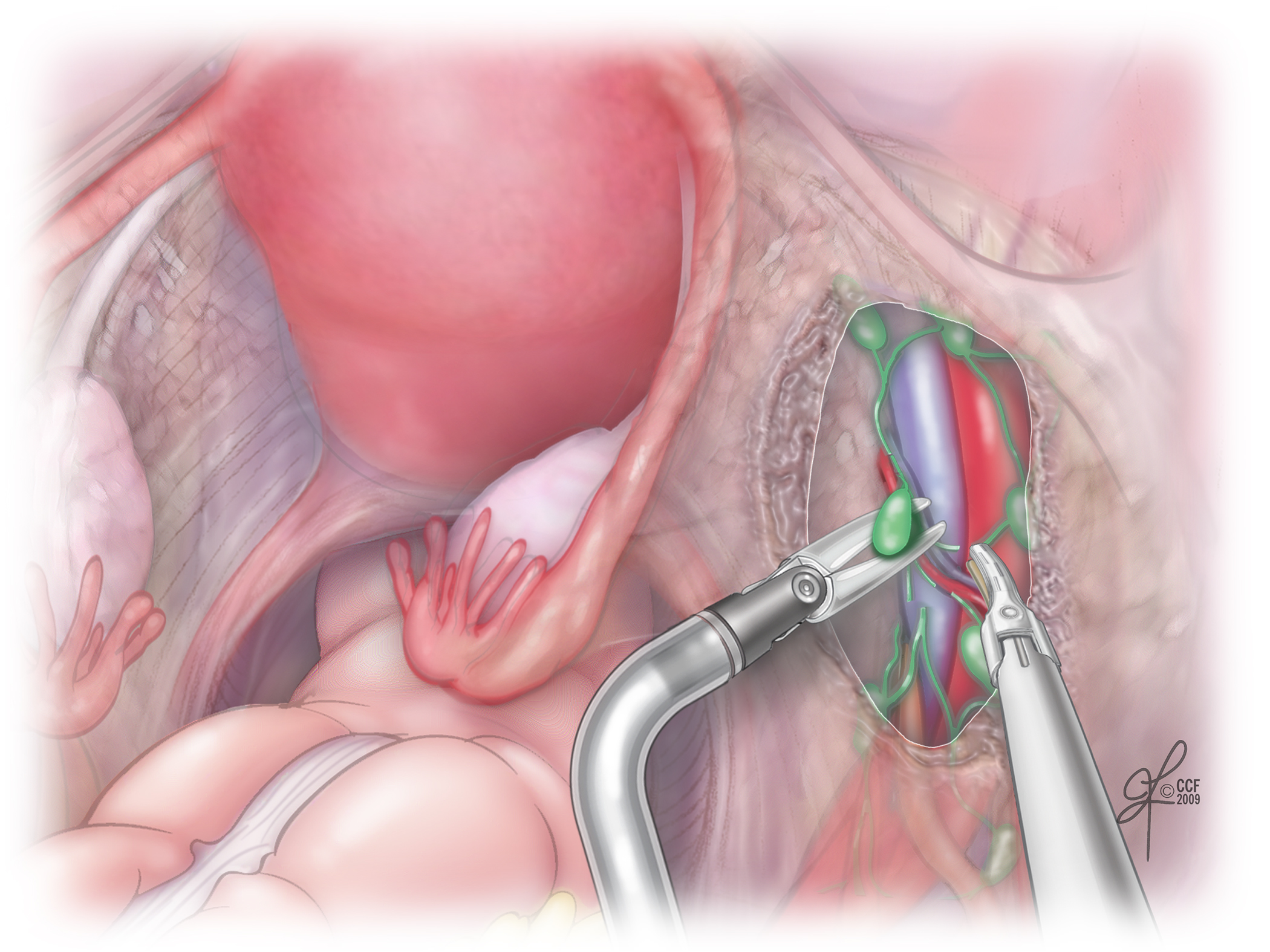 endometrium rák tumor markerek