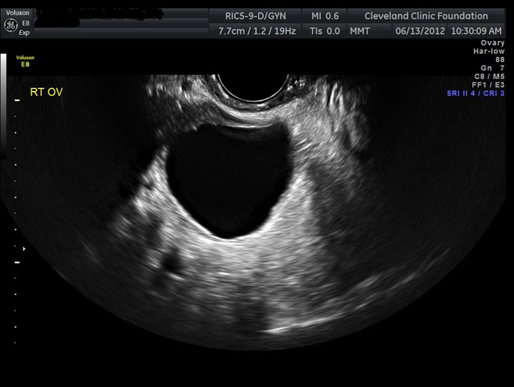 how big is an ovary