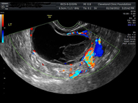 Hemorrhagic cyst