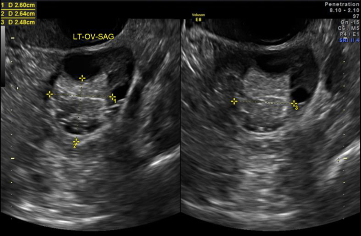 Should You Be Worried About an Ovarian Cyst? - Sunshine State