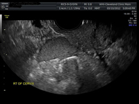 Endometrioma