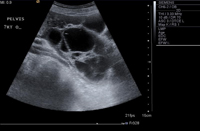 Ovarian malignancy